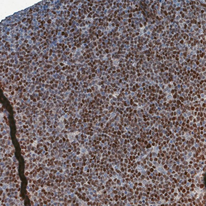 Staining of human mantle cell lymphoma shows moderate to strong nuclear positivity in tumor cells.