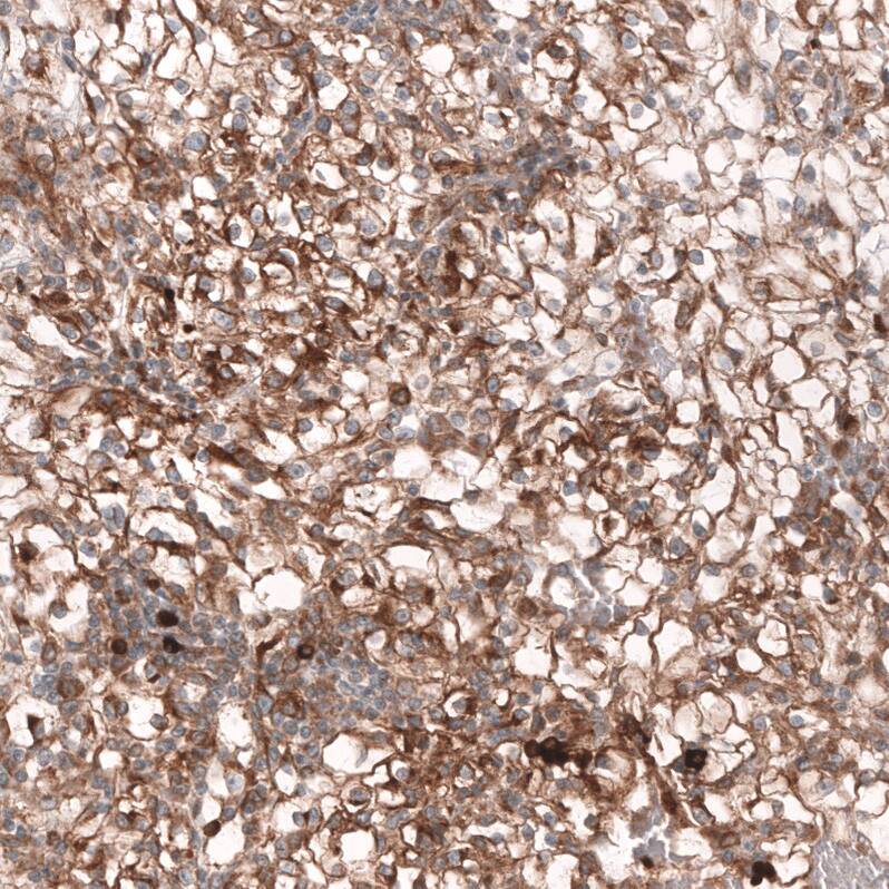 Staining of human kidney cancer shows moderate to strong membranous positivity in tumor cells.