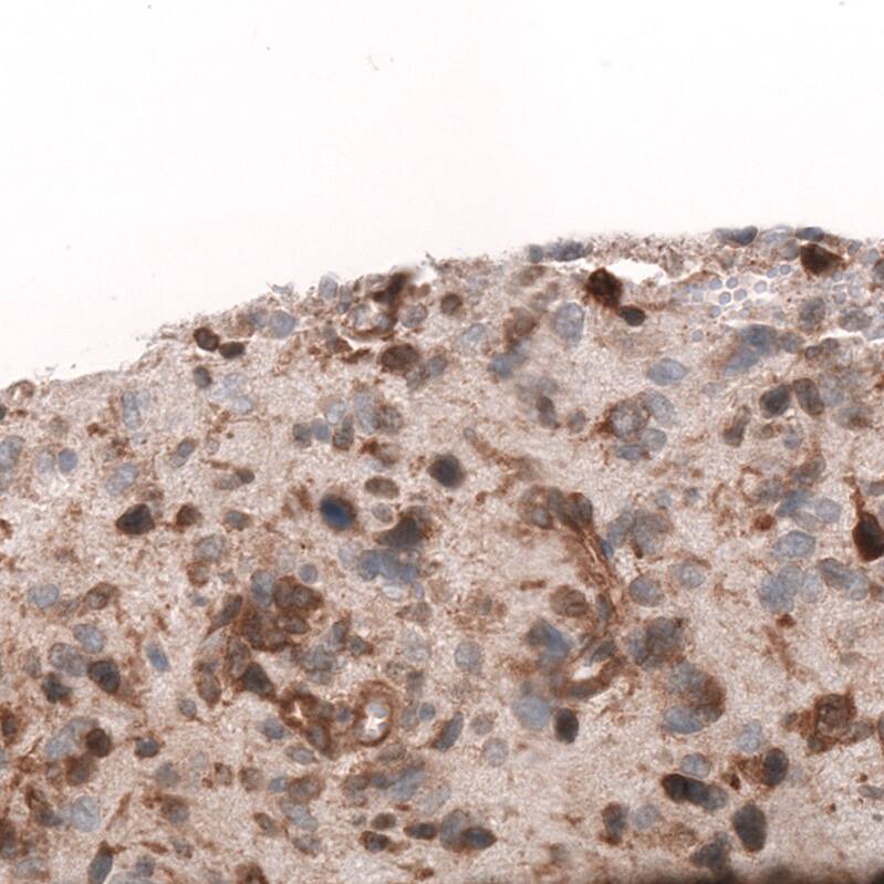 Staining of human glioblastoma multiforme shows moderate to strong cytoplasmic positivity in tumor cells.