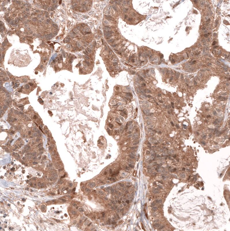 Staining of human colorectal cancer shows moderate cytoplasmic positivity in tumor cells.