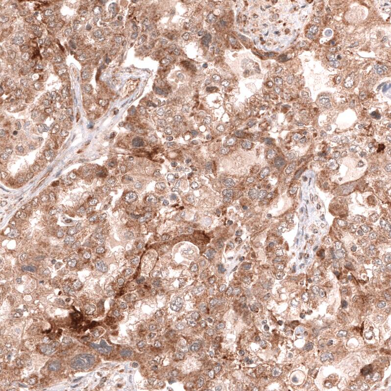 Staining of human ovarian cancer (endometrioid carcinoma) shows moderate cytoplasmic positivity in tumor cells.