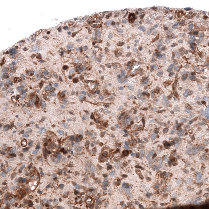 Staining of human glioblastoma multiforme shows moderate to strong cytoplasmic positivity in tumor cells.