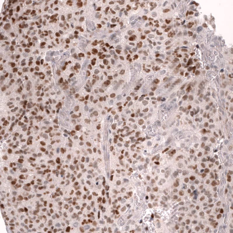 Staining of human anaplastic oligodendroglioma shows strong nuclear positivity in neurons.