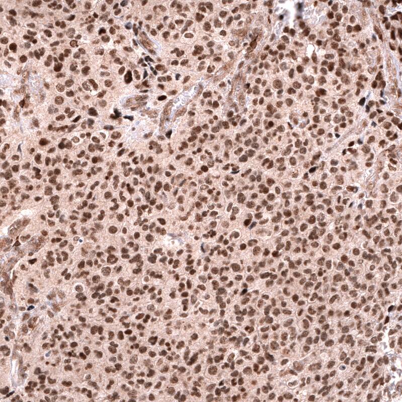 Staining of human anaplastic oligodendroglioma shows strong nuclear positivity in tumor cells.