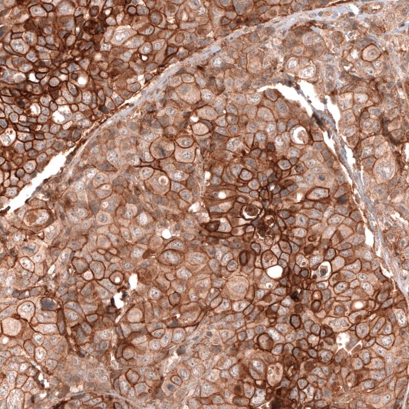 Staining of human breast cancer shows strong membranous positivity in tumor cells.