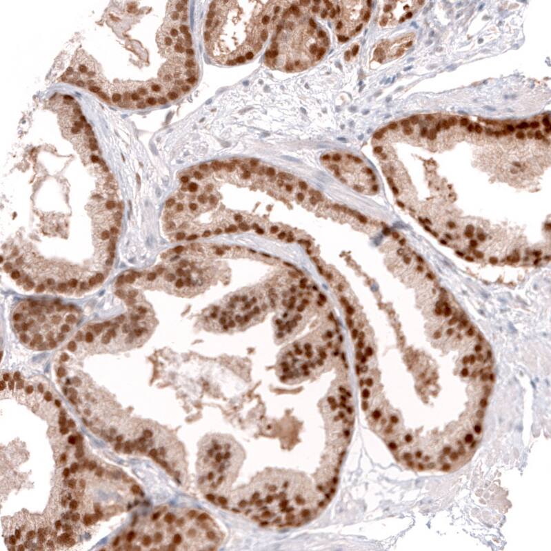 Staining of human prostate cancer shows strong nuclear positivity in tumor cells.