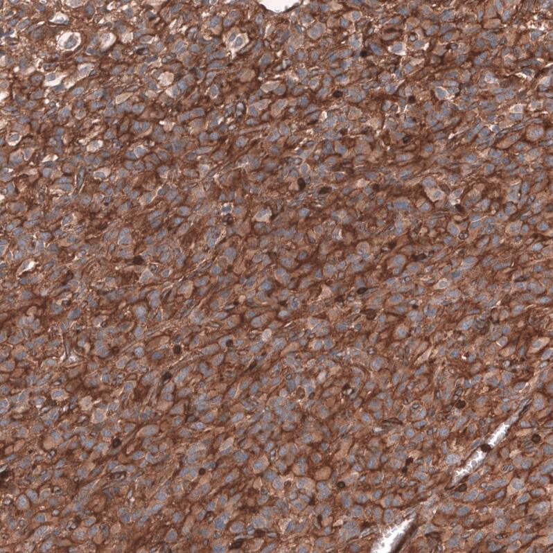 Staining of human anaplastic oligodendroglioma shows strong membranous positivity in tumor cells.