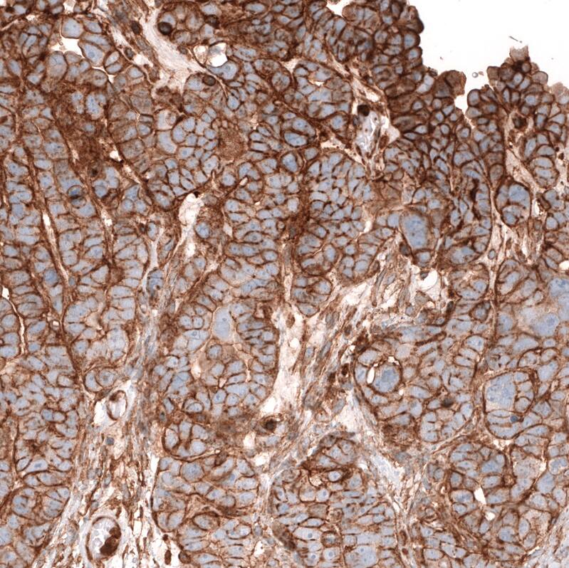 Staining of human ovarian cancer (papillary carcinoma) shows strong membranous positivity in tumor cells.