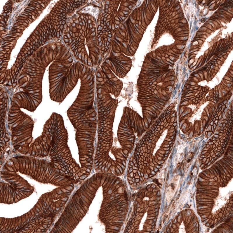 Staining of human ovarian cancer (low grade serous ovarian carcinoma) shows strong membranous positivity in tumor cells.