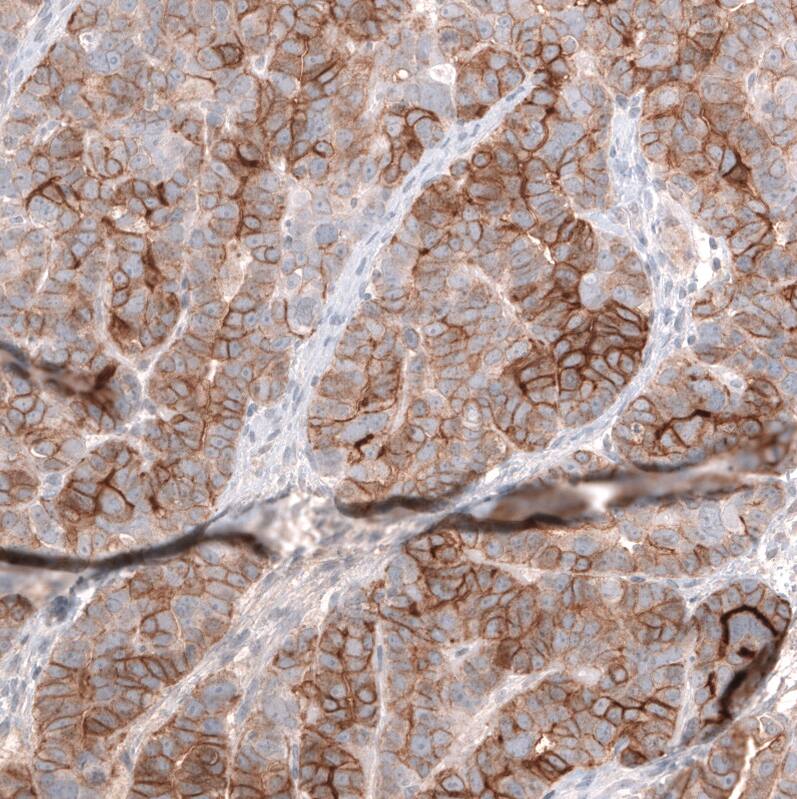 Staining of human ovarian cancer (papillary carcinoma) shows strong membranous positivity in tumor cells.