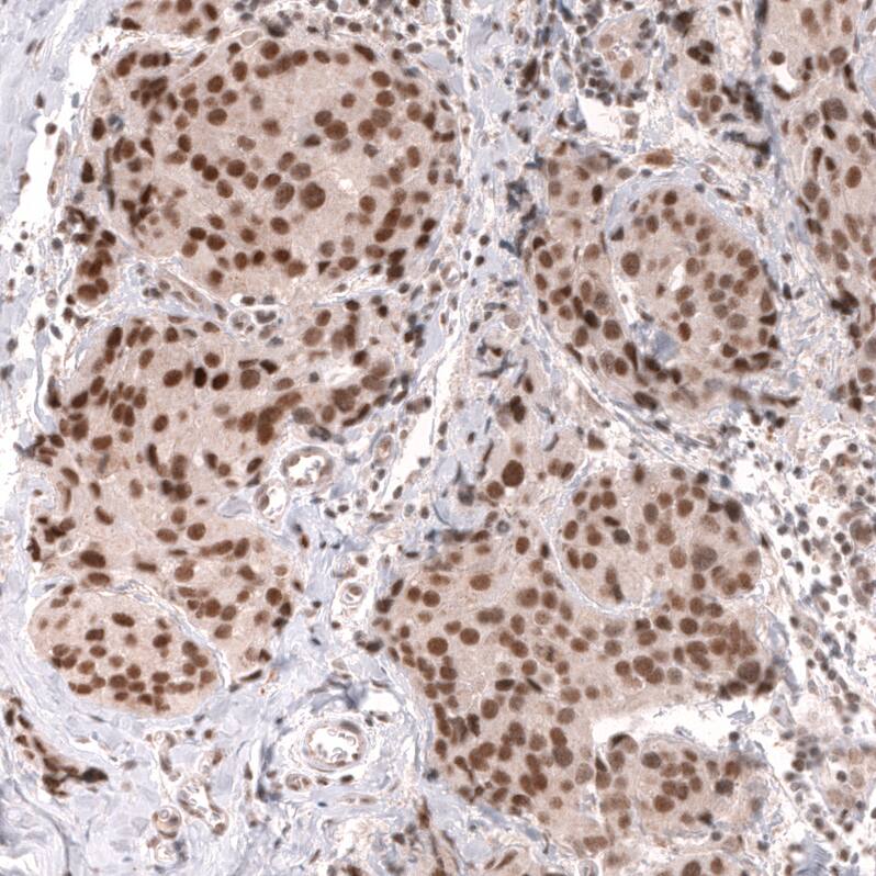 Staining of human breast cancer (ductal carcinoma) shows strong nuclear positivity in tumor cells.