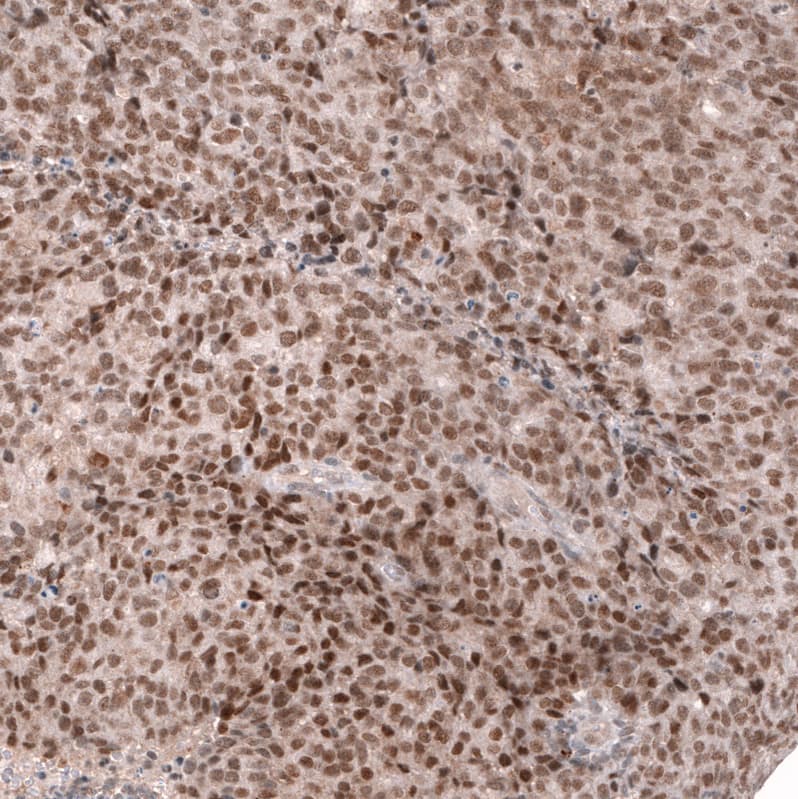Staining of human endometrial cancer shows strong nuclear positivity in tumor cells.
