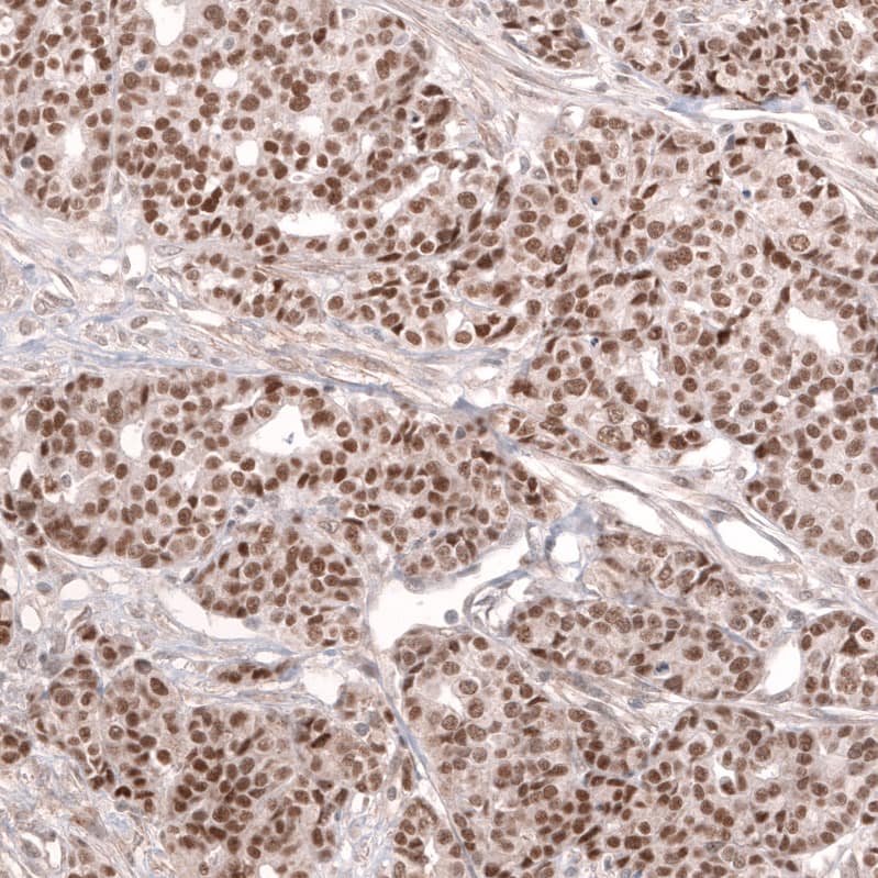 Staining of human ovarian cancer (high grade serous ovarian carcinoma) shows strong nuclear positivity in tumor cells.