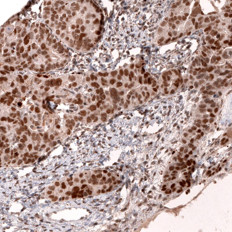 Staining of human ovarian cancer (papillary carcinoma) shows strong nuclear positivity in tumor cells.