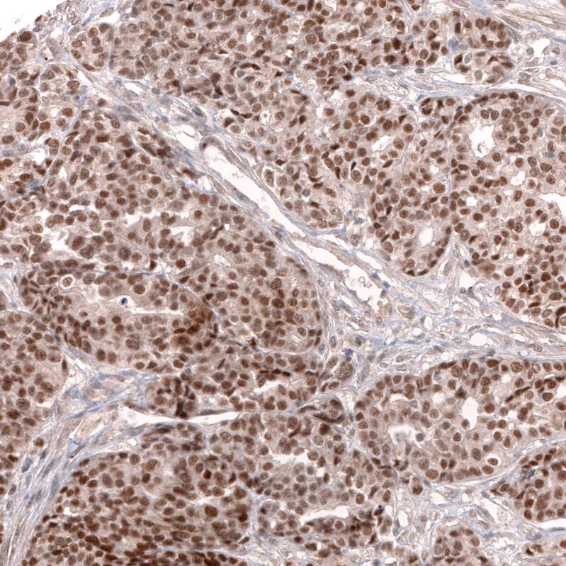 Staining of human ovarian cancer (high grade serous ovarian carcinoma) shows strong nuclear positivity in tumor cells.
