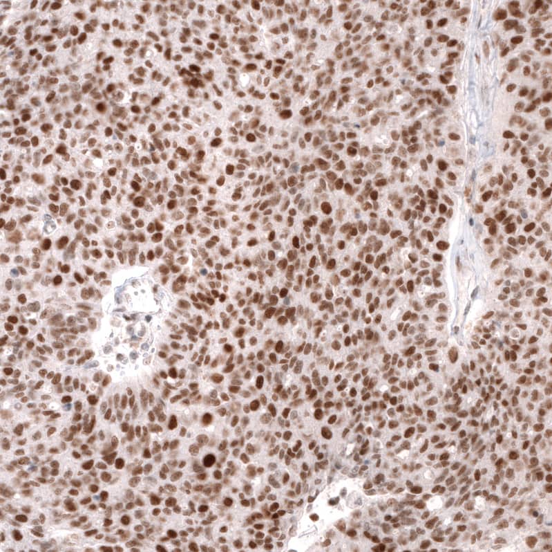Staining of human ovarian cancer (high grade serous ovarian carcinoma) shows strong nuclear positivity in tumor cells.