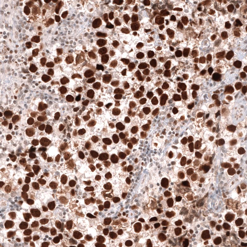 Staining of human testis cancer (seminoma) shows strong nuclear positivity in tumor cells.