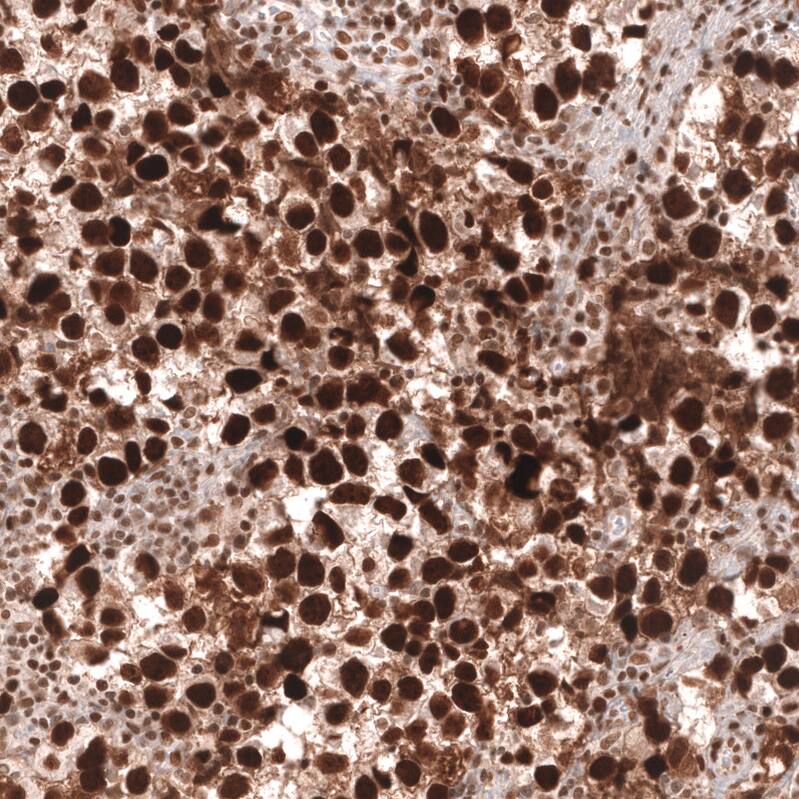 Staining of human testis cancer (seminoma) shows strong nuclear positivity in tumor cells.