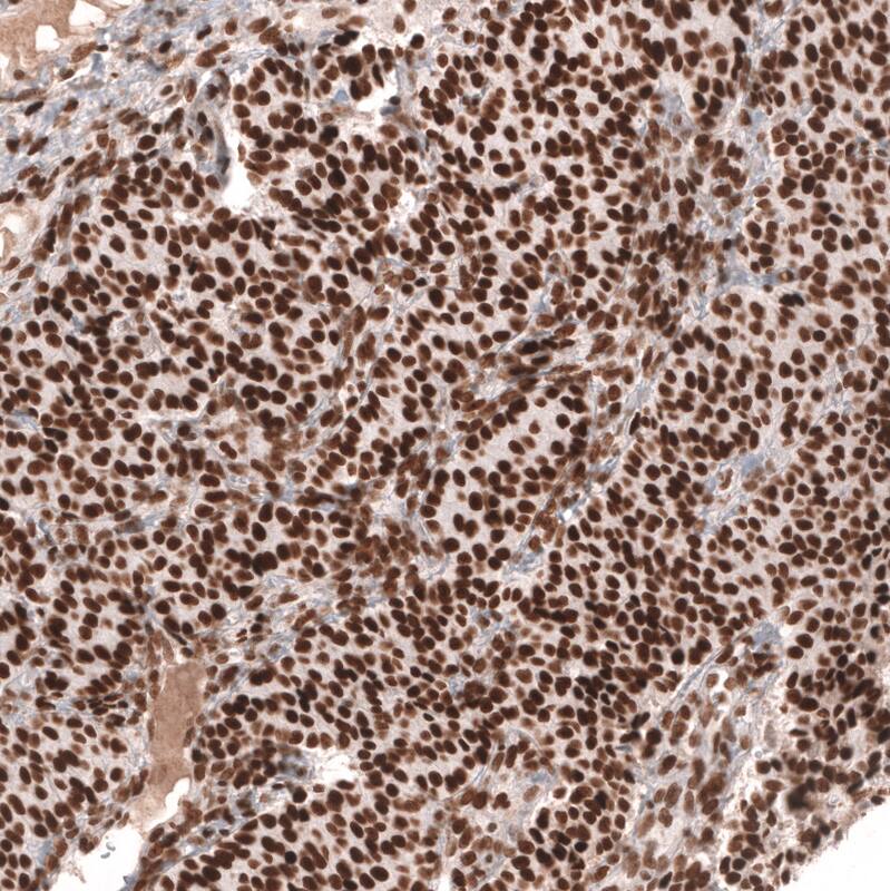 Staining of human ovarian cancer (sex cord tumor) shows strong nuclear positivity in tumor cells.