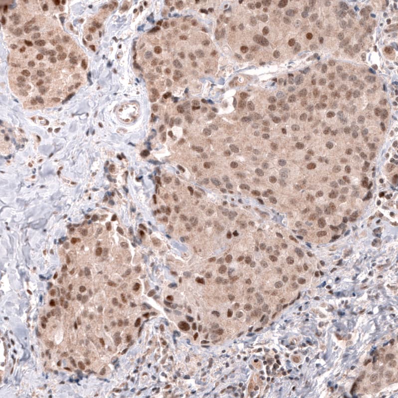 Staining of human breast cancer shows moderate to strong nuclear positivity in tumor cells.