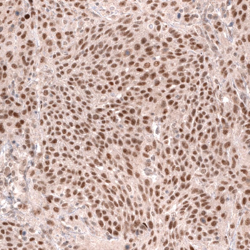 Staining of human cervical cancer shows strong nuclear positivity in tumor cells.