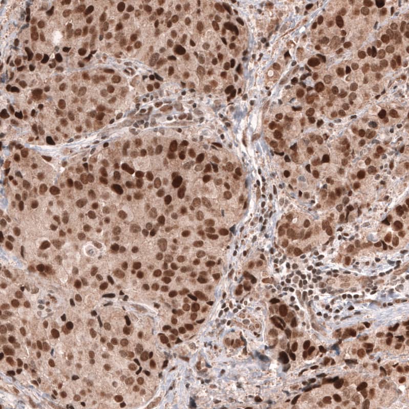 Staining of human breast cancer (ductal carcinoma) shows strong nuclear positivity in tumor cells.