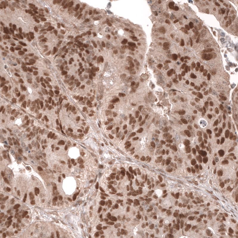 Staining of human colorectal cancer shows strong nuclear positivity in tumor cells.