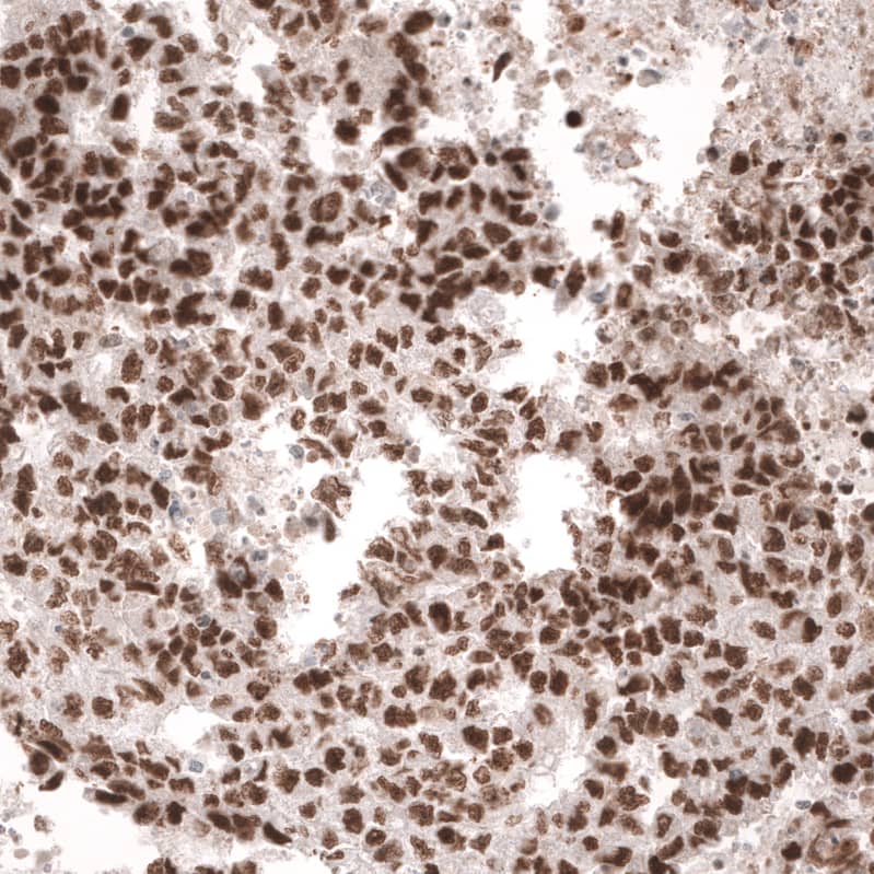 Staining of human testis cancer (embryonal carcinoma) shows strong nuclear positivity in tumor cells.