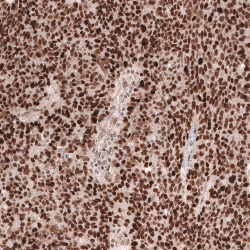 Staining of human ovarian cancer (high grade serous carcinoma) shows strong nuclear positivity in tumor cells.