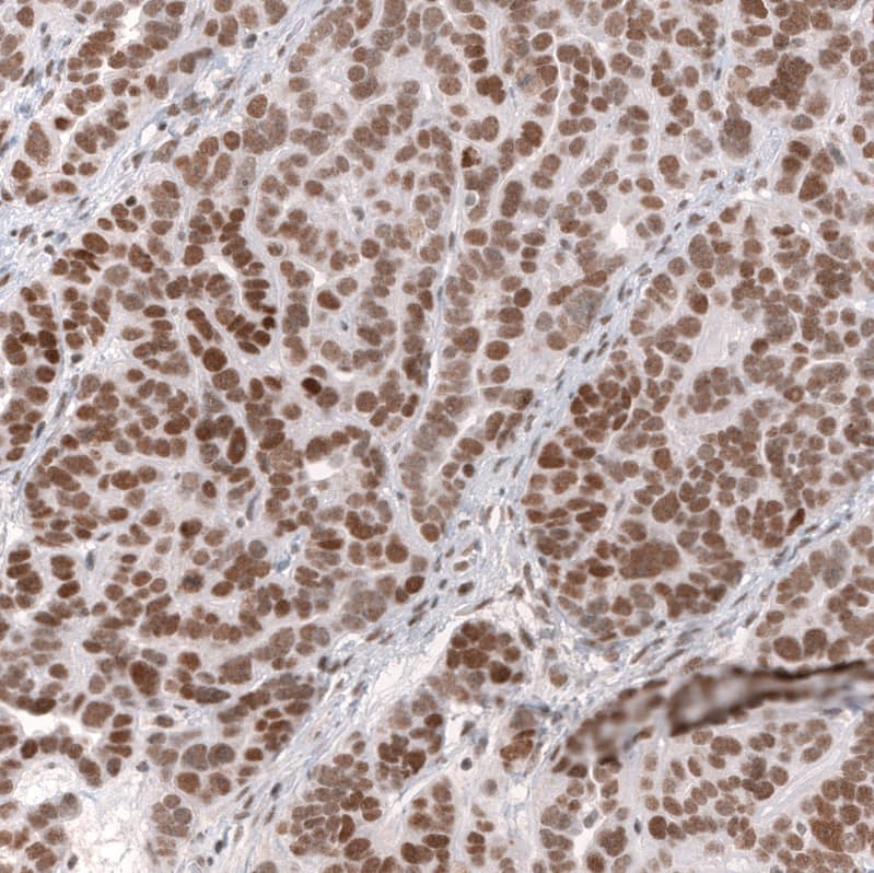 Staining of human ovarian cancer shows strong nuclear positivity in tumor cells.