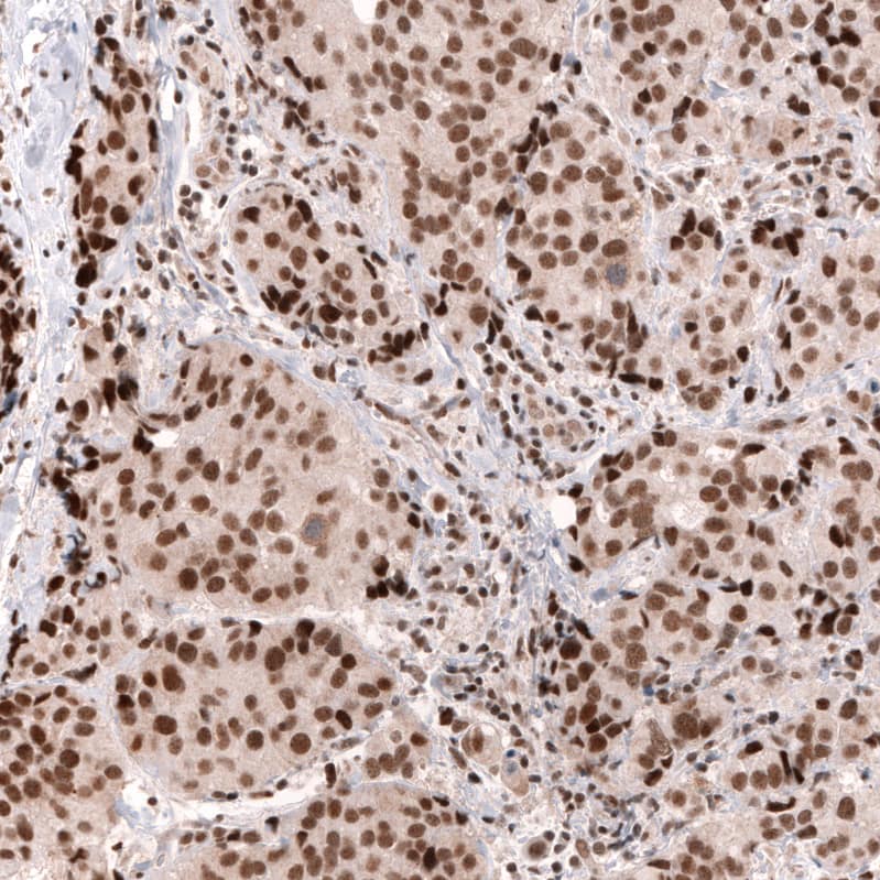 Staining of human breast cancer (ductal carcinoma) shows strong nuclear positivity in tumor cells.