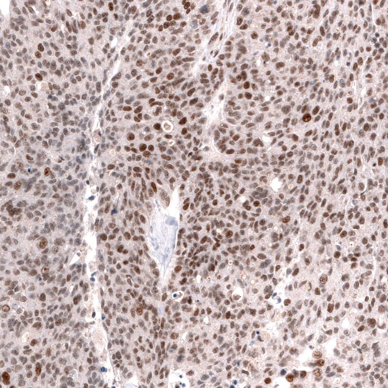 Staining of human ovarian cancer (high grade serous ovarian carcinoma) shows moderate to strong nuclear positivity in tumor cells.