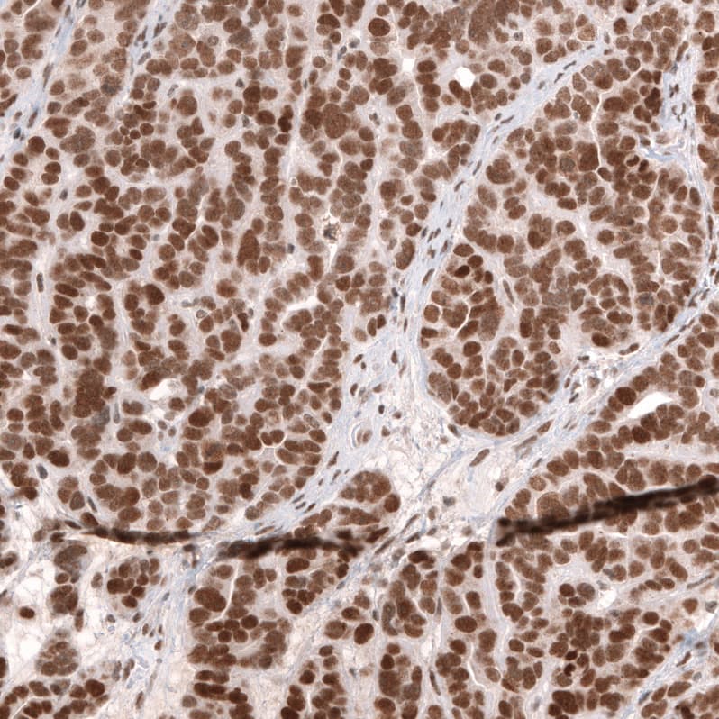 Staining of human ovarian cancer 8papillary carcinoma) shows strong nuclear positivity in tumor cells.