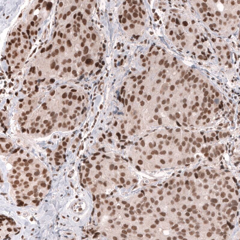 Staining of human breast cancer (ductal carcinoma) shows strong nuclear positivity in tumor cells.
