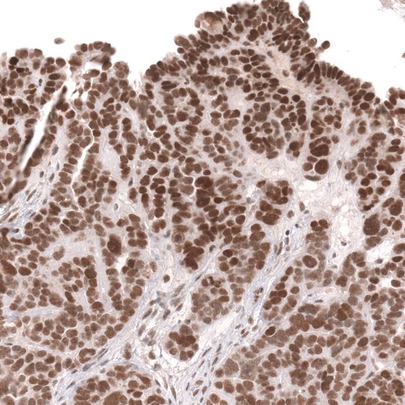 Staining of human ovarian cancer (papillary carcinoma) shows moderate to strong nuclear positivity in tumor cells.