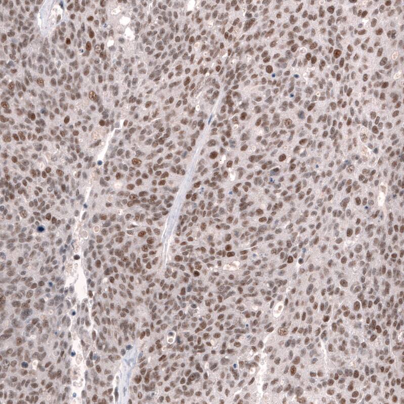 Staining of human ovarian cancer (high grade serous carcinoma) shows moderate to strong nuclear positivity in tumor cells.