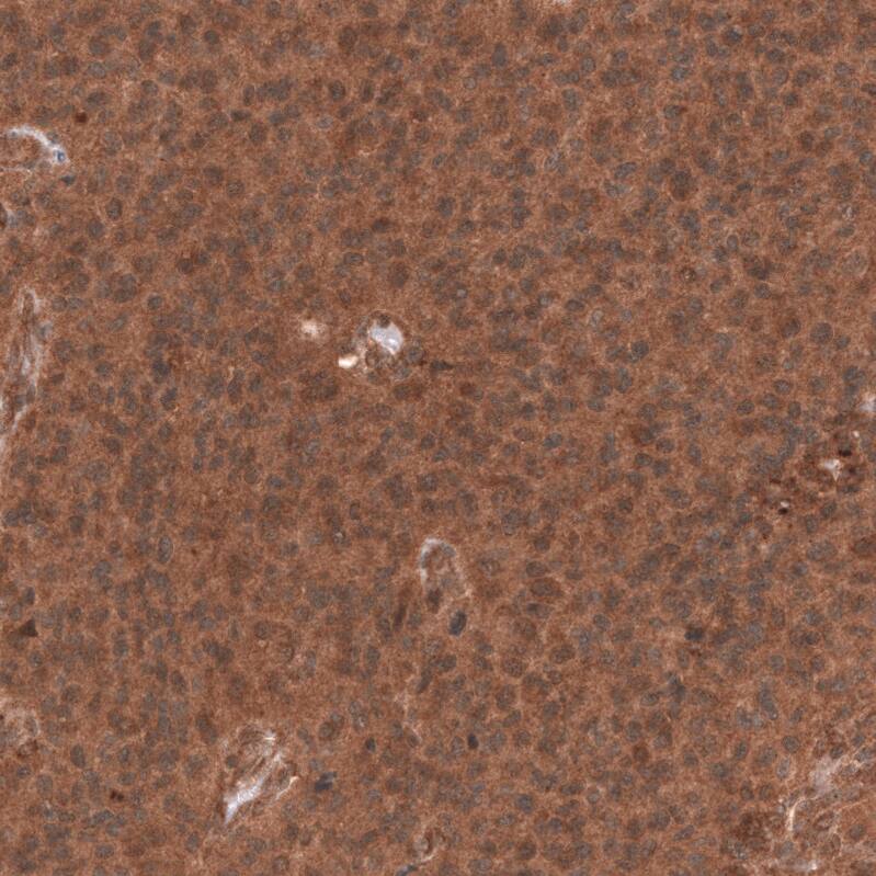 Staining of human anaplastic oligodendroglioma shows strong cytoplasmic positivity in tumor cells.