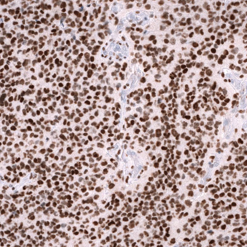 Staining of human anaplastic oligodendroglioma shows strong nuclear positivity in tumor cells.