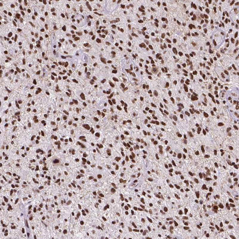 Staining of human glioma shows strong nuclear positivity in tumor cells.