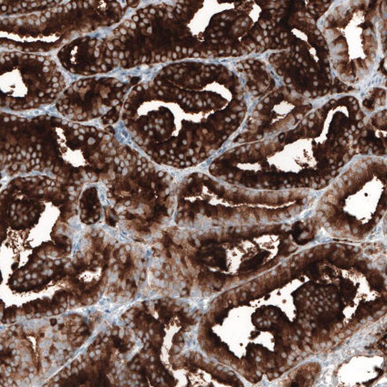 Staining of human prostate cancer shows strong cytoplasmic positivity in glandular cells.