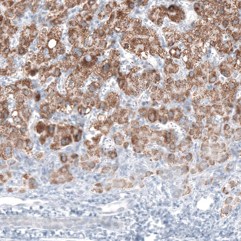 Staining of human liver cancer shows moderate granular cytoplasmic positivity in tumor cells.