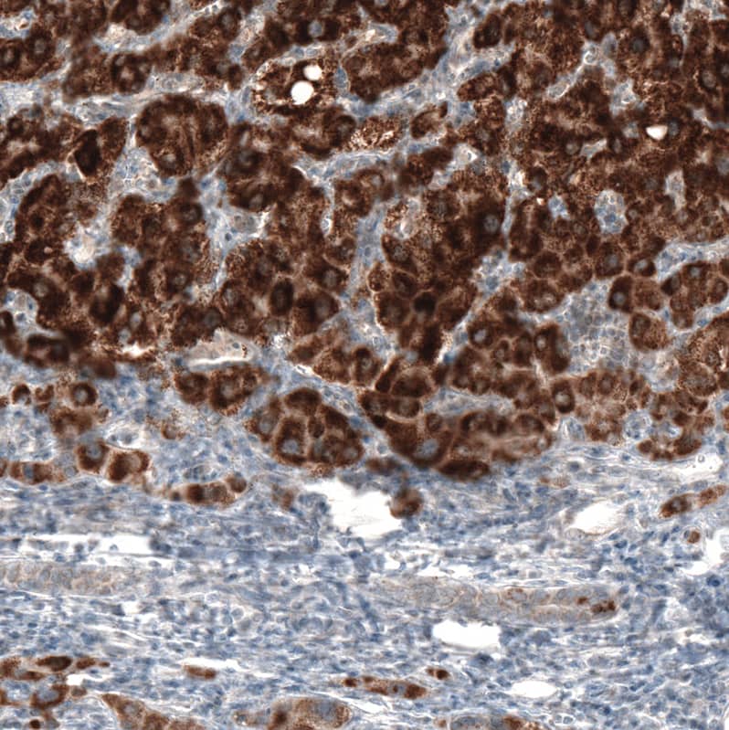 Staining of human liver cancer shows strong granular cytoplasmic positivity in tumor cells.