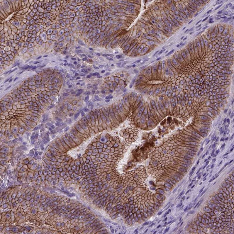 Staining of human colorectal cancer shows moderate to strong membranous positivity in tumor cells.