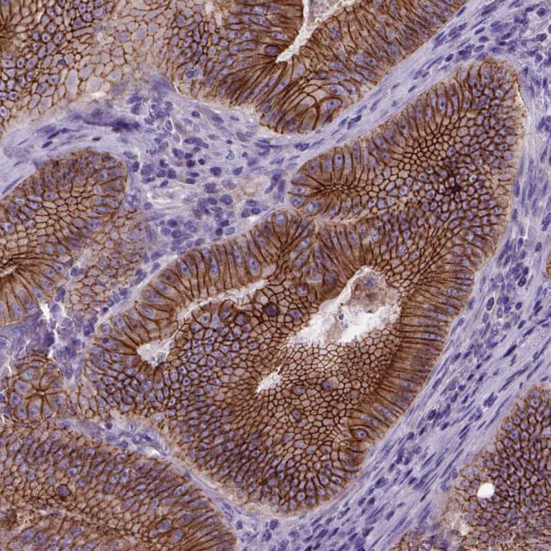 Staining of human colorectal cancer shows strong membranous positivity in tumor cells.