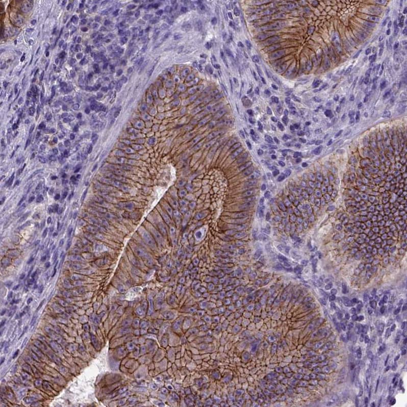 Staining of human colorectal cancer shows strong membranous positivity in tumor cells.