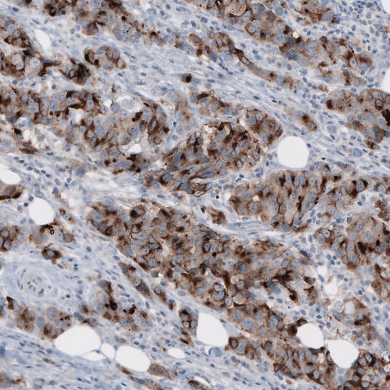 Staining of human breast cancer shows strong cytoplasmic positivity.