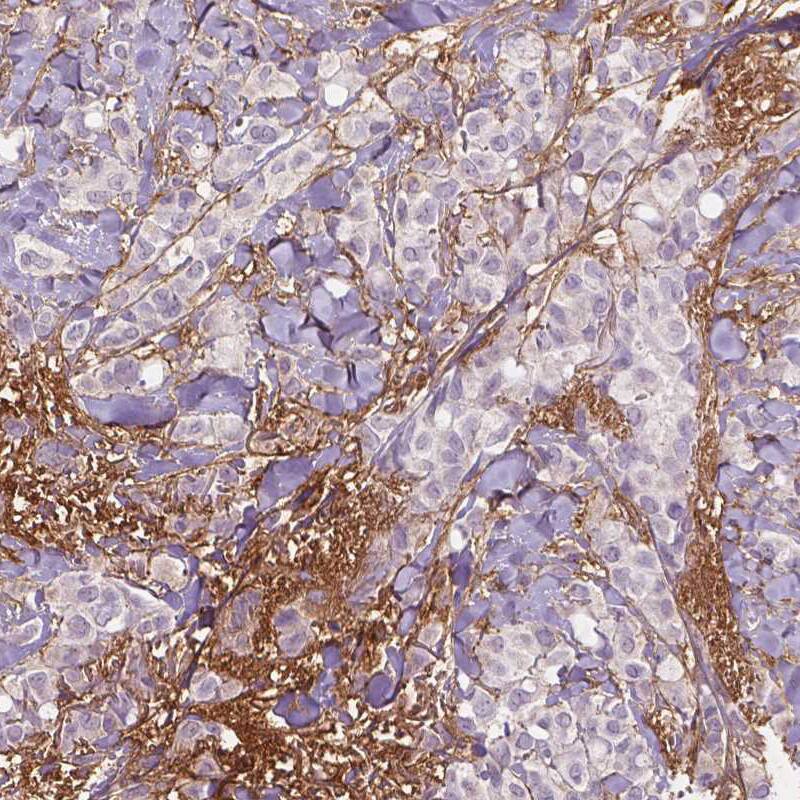 Staining of human breast cancer shows moderate positivity in the extracellular matrix of tumor stroma.