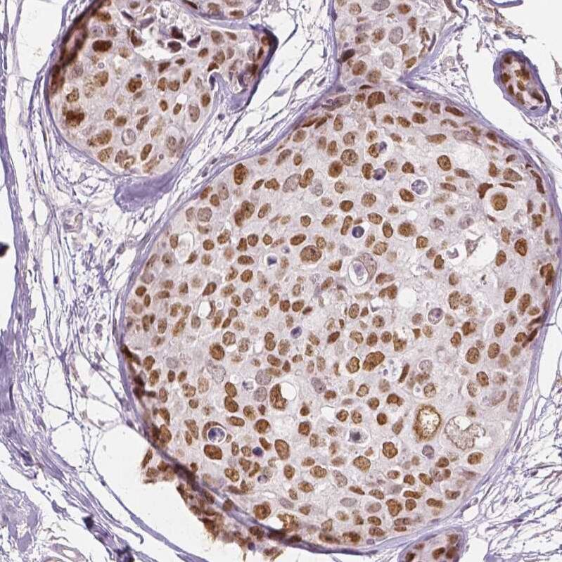 Staining of human breast cancer shows moderate nuclear positivity in tumor cells.