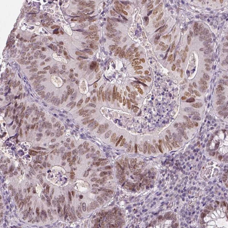 Staining of human colorectal cancer shows moderate nuclear positivity in tumor cells.