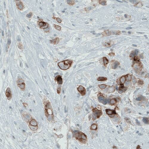 Staining of human breast cancer shows membranous immunoreactivity in tumor cells.